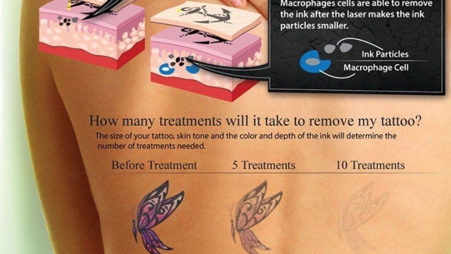 Safe Tattoo Removal For Women