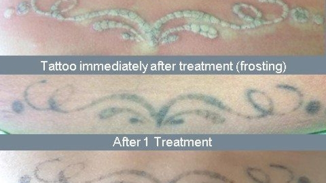 Tattoo Removal – Start Properly