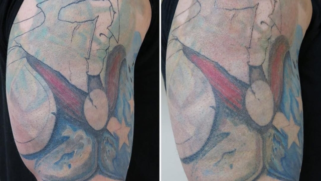 Tattoo Removal Becoming A Fad