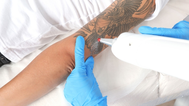 What Is Involved With Tattoo Reduction?