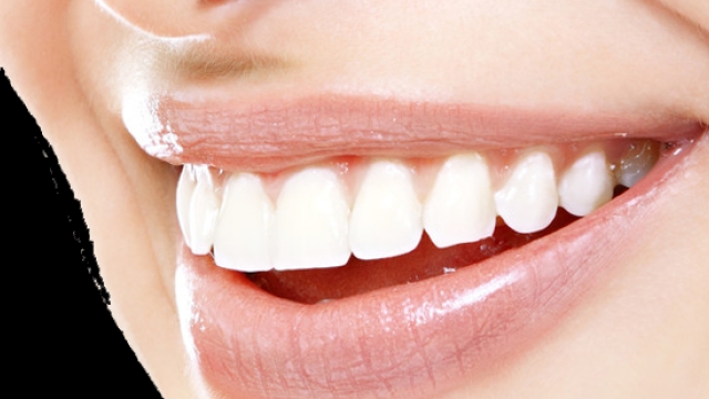 Sparkling Smiles: The Ultimate Guide to Teeth Whitening