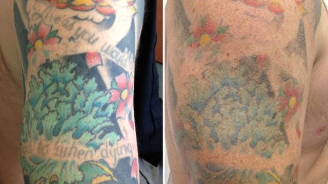 Tattoo Removal Information – What Are Your Tattoo Removal Options?