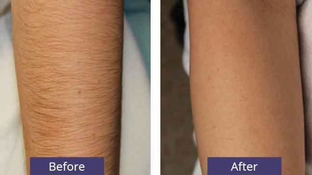 Say Goodbye to Unwanted Hair: The Ultimate Guide to Laser Hair Removal