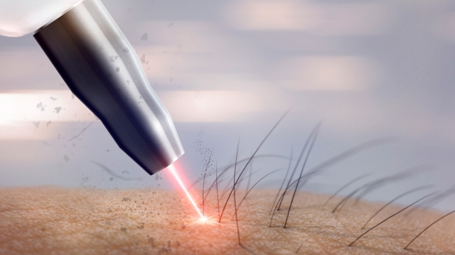 Say Goodbye to Unwanted Hair: The Amazing World of Laser Hair Removal