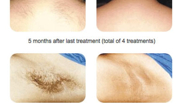 Unveiling the Secrets of Laser Hair Removal: A Smooth Path to Perfection